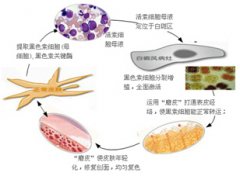 黑素母液细胞植补术是啥？有啥优势？