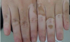 <b>手部白斑出现的原因和治疗办法</b>